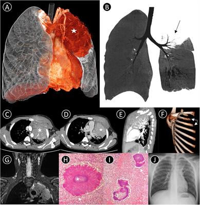 Pediatric pulmonary actinomycosis: A misdiagnosed case report